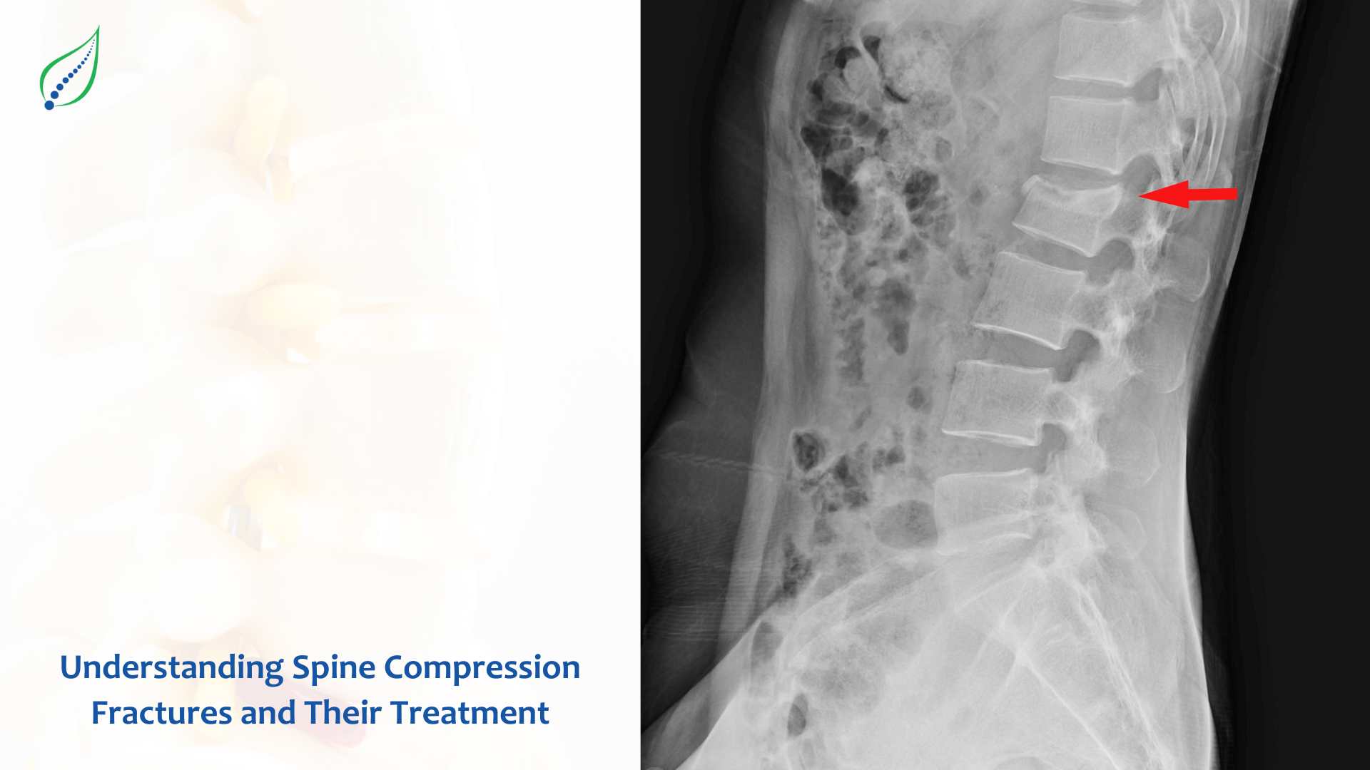 Understanding Spine Compression Fractures and Their Treatment